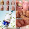 Anti Fungus Nail Onychomycosis Nail Repair Treatment Liquid Cleanser Herbal Disinfection Serum