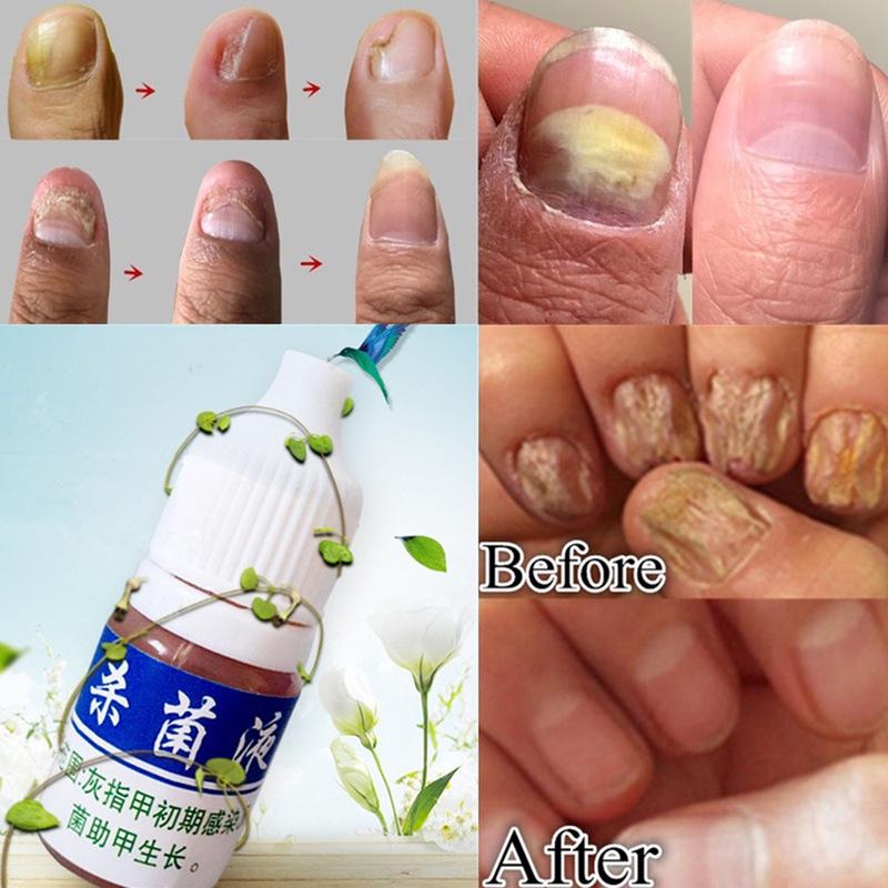 Anti Fungus Nail Onychomycosis Nail Repair Treatment Liquid Cleanser Herbal Disinfection Serum