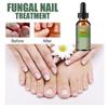 Hand and Foot Nail Onycho Repair Nail Onychomycetant for Thickening Nail Suppressant