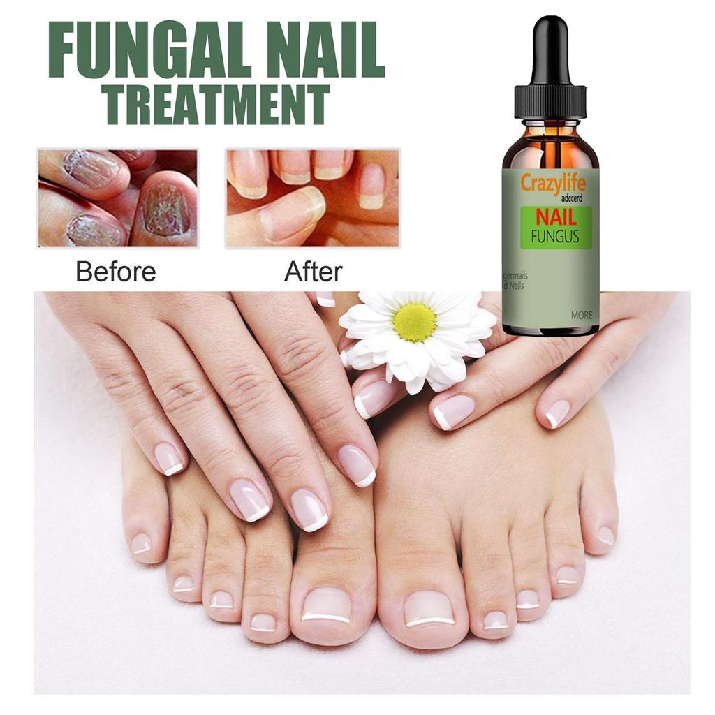 Hand and Foot Nail Onycho Repair Nail Onychomycetant for Thickening Nail Suppressant