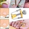 Ingrown Toenail Toe Fixer Recover Correction Device Pedicure Foot Nail Care Tool