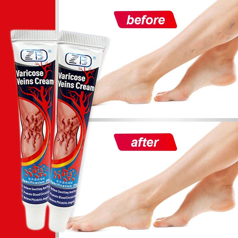 ZB Relief Paste Improve Blood Circulations Spider For Tired Heavy Legs Fast Relief Ointment 20g