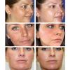 Whitening Freckle Cream Remove Melasma Spot Acne Pigment Melanin Dark Spots Pigmentation Freckle Removal Cream