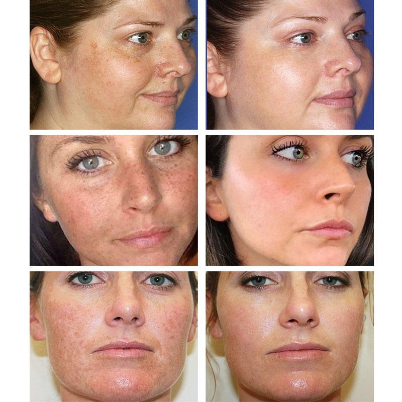 Whitening Freckle Cream Remove Melasma Spot Acne Pigment Melanin Dark Spots Pigmentation Freckle Removal Cream