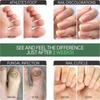 Hand and Foot Nail Onycho Repair Nail Onychomycetant for Thickening Nail Suppressant