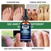 5ML/15ML/30ML/50ML/Crazylife Hand And Foot Nail Onycho Repair Nail Onychomycetant For Thickening Nail Suppressant