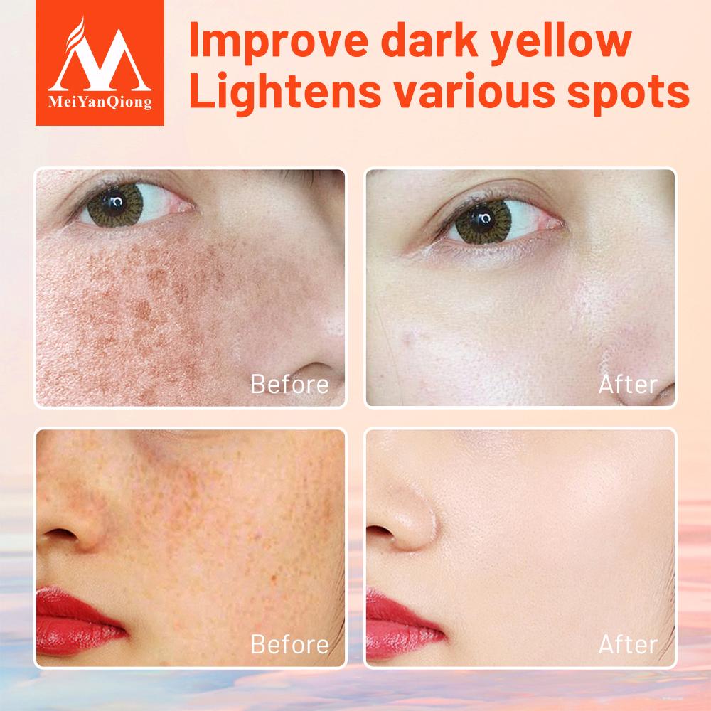 Freckle Cream Skin Care Whitening Anti-aging Moisturizing Cream Melanin Removing Freckle Speckle Firm Skin Care Face Care