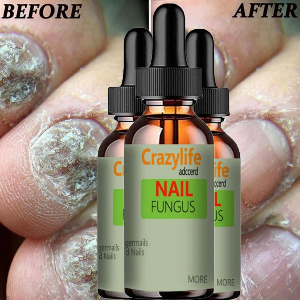 Hand and Foot Nail Onycho Repair Nail Onychomycetant for Thickening Nail Suppressant