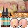 30ml Nail Fungal Liquid Anti Fungal Nail Solution for Finger and Toe Nails